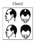 CLASS 2 HAIR LOSS