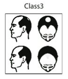 CLASS 3 HAIR LOSS