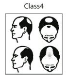 CLASS 4 HAIR LOSS